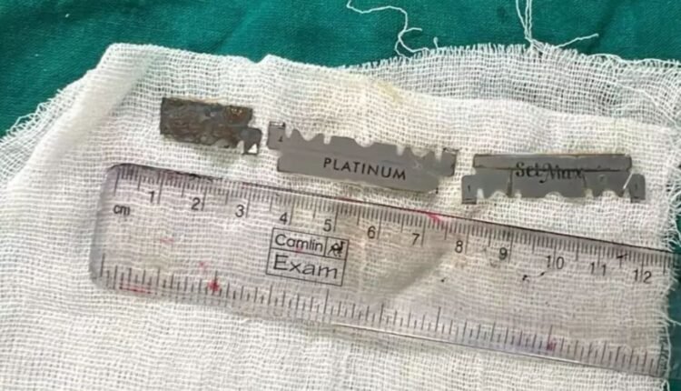 Blade fragments removed from boy at Osmania